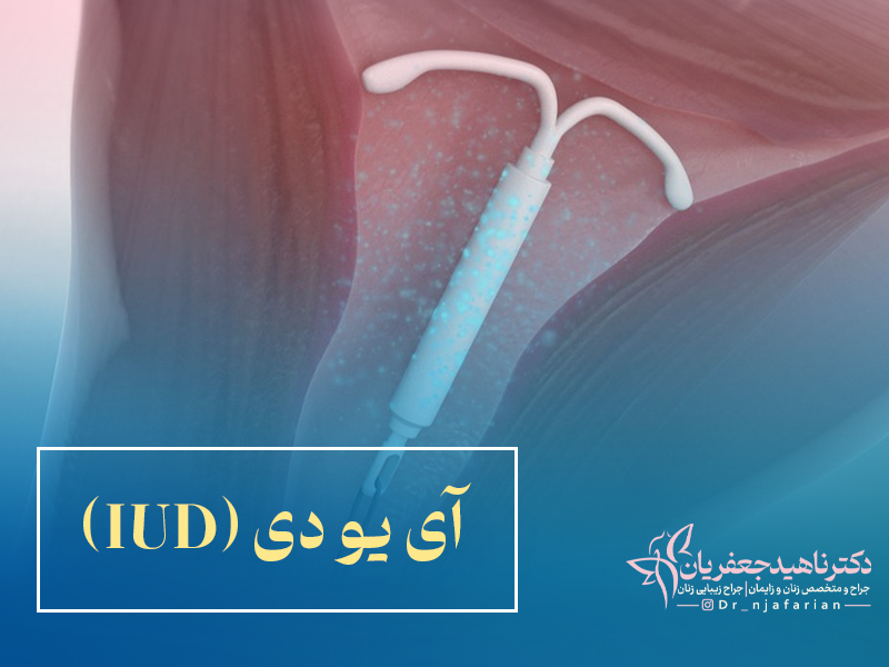آی یو دی (IUD) چیست؟